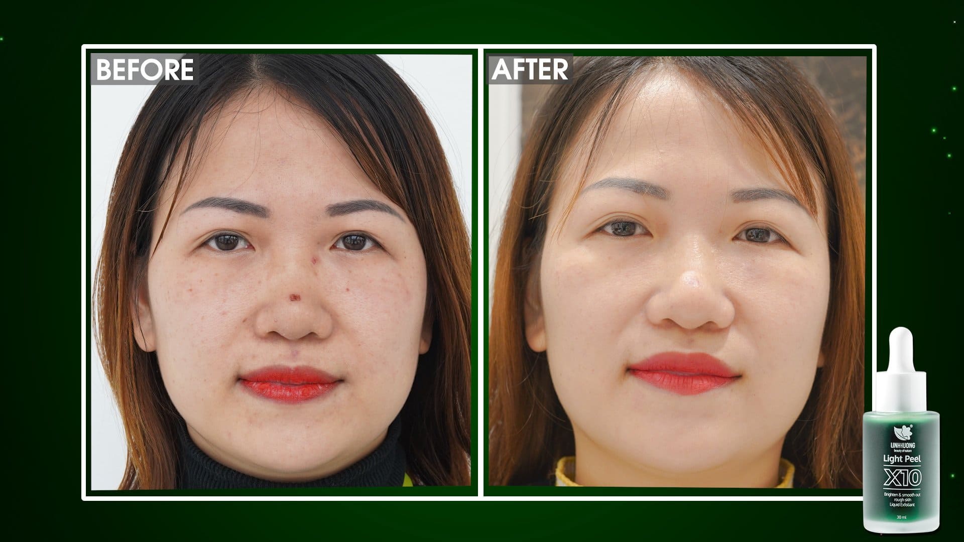 Phản hồi sản phẩm Light Peel X10